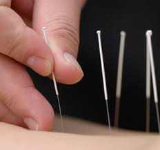 Agulhas de acupuntura são muito finas e sempre descartáveis